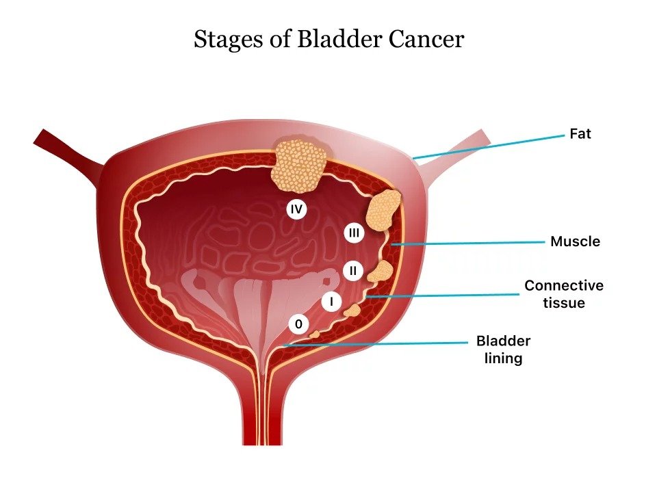 Stages-of-Bladder-Cancer Bladder-Cancer