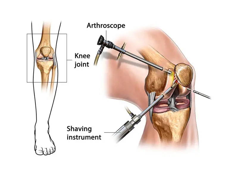 knee-arthroscopy-illustration.jpg