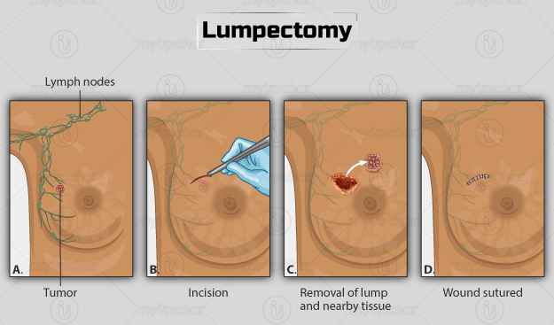 lumpectomy lumpectomy