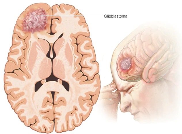 Brain Tumor Brain Tumor
