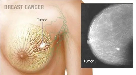 Breast Cancer Breast Cancer