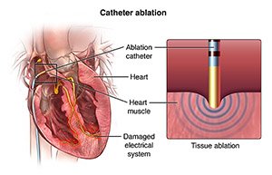 Front view of ablation catheter guided into the heart and ablating heart muscle inset CATHETER ABLATION