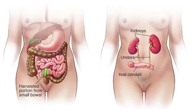 Cystectomy Cystectomy