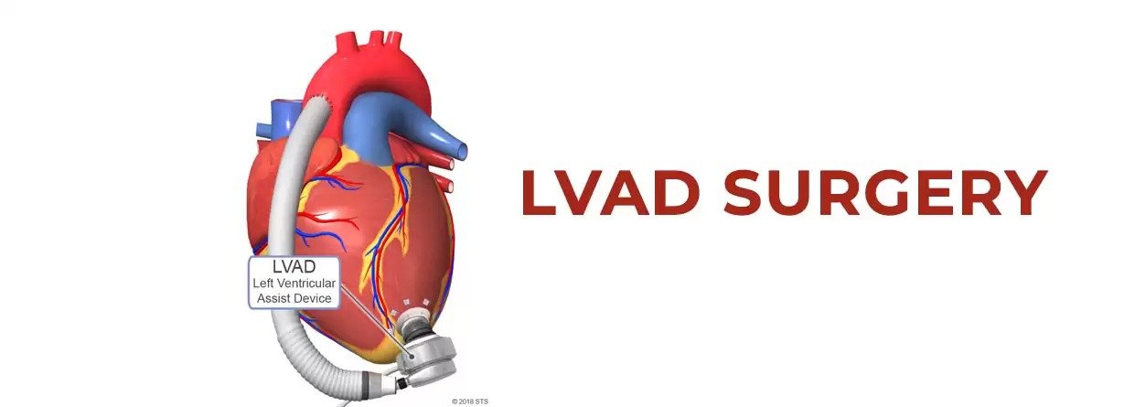LVAD Surgery