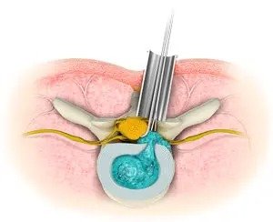 Minimally Invasive Spine Surgery Minimally Invasive Spine Surgery
