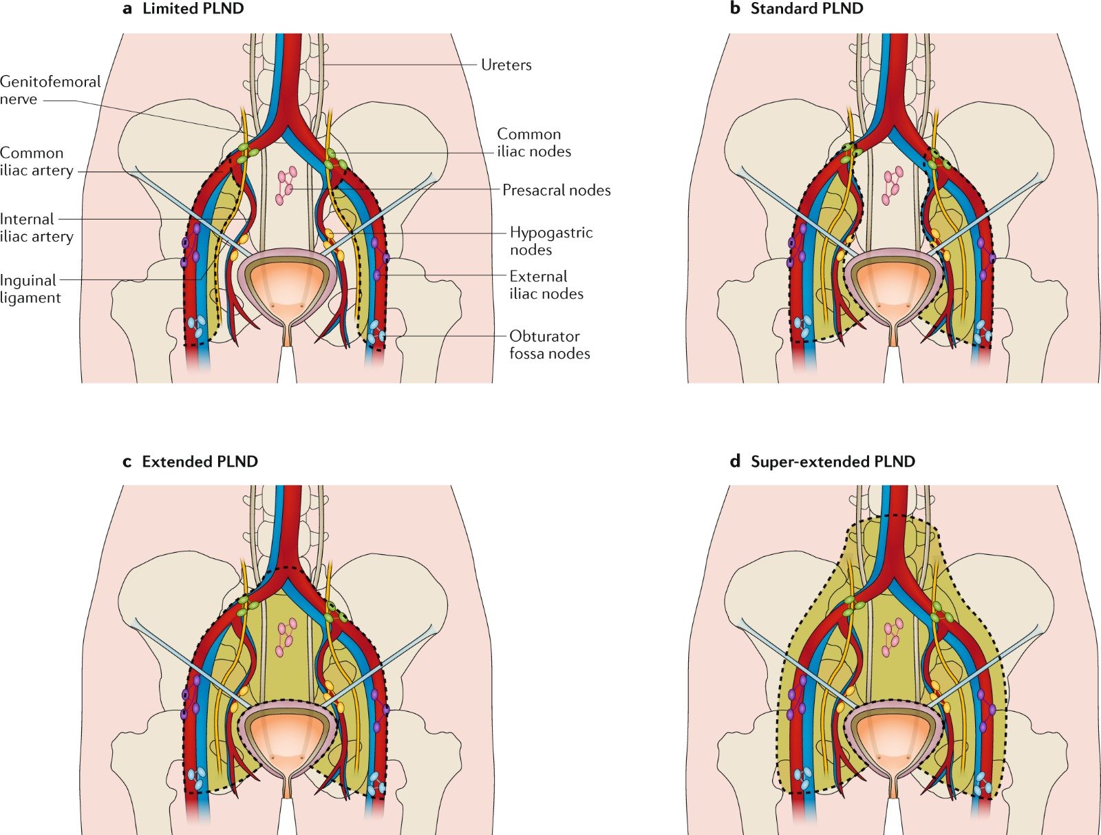 pelvic-lymph-node-dissection-plnd-cure-2-world