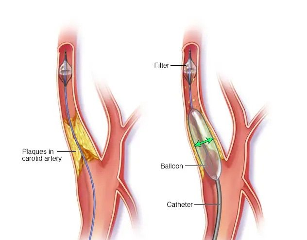 Radical Prostatectomy Radical Prostatectomy
