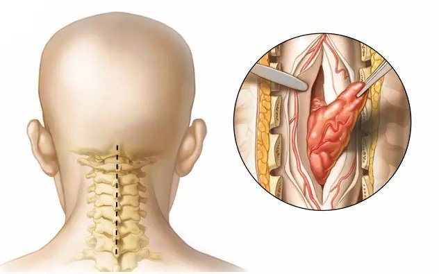 Spine Tumor Surgery Spine Tumor Surgery