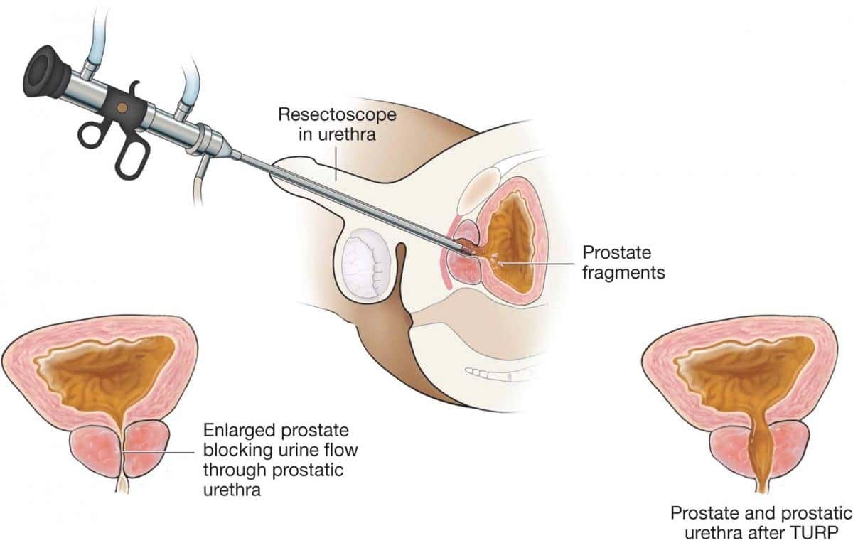 Transurethral Resection of the Prostate (TURP) Understanding Transurethral Resection of the Prostate (TURP): Types and Procedure