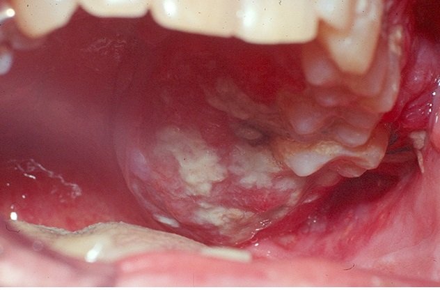 oral cancer